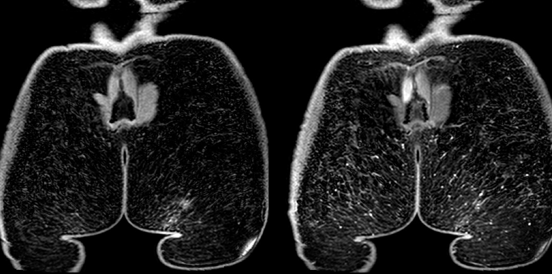 Figure 4 for case Silicon granuloma gluteal augmentation